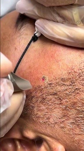 Removal of moles, warts, and skin tags using laser technology