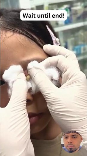 Popping huge blackheads and Giant Pimples- Best Pimple Popping Videos#blackheads #pimplepopping