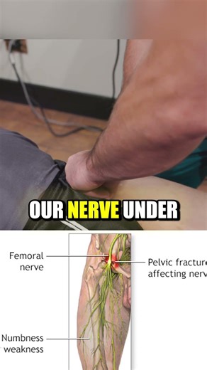 Obturator Nerve Treatment That Actually Works #nervepain #hippain #shorts