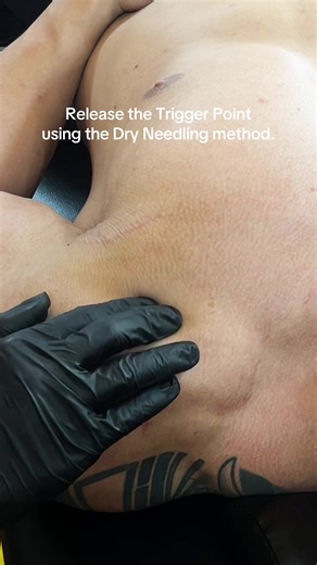 Release the trigger point using the Dry Needling method. #physio #dryneedling #physiotherapist #triggerpoints #sportmassage #fyp