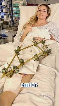 Inside Lindsey Vonn’s Severe Open Fracture and Recovery Timeline