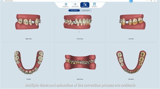 4.1K views · 33 reactions | ✨ Orthodontic Simulation with Helios ✨ -A preview of the future smile- With Helios, you can instantly simulate orthodontic outcomes chairside, helping patients visualize their treatment path and boosting case acceptance. In this demo, see how streamlined steps and smoother controls make the process even more intuitive. #Eighteeth #Helios700 #IntraoralScanner #HeliosSeries #SmileSimulation #OrthodonticSimulation #DigitalDentistry | Eighteeth Medical | Facebook