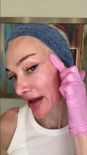 Say hello to smoother skin with MicroNeedling - MD Needle Pen