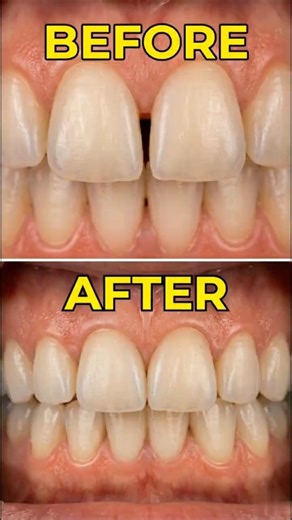 Black Triangle Gone Instantly 😱🦷 | #dentist #toothcraft #satisfying