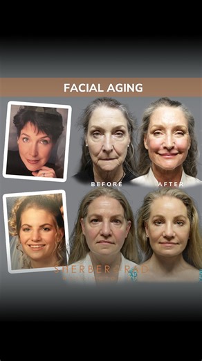 Ariel N. Rad, M.D., Ph.D., F.A.C.S. on Instagram: "🎯 Facial aging is related to soft tissue thinning and droop as well as to thinning and atrophy of bone structure. 💀 Both tissue and bone shrinkage contribute to volume disproportions that show as age-related under eye bags, sagging brows, eyelids and cheeks, as well as jowls and heavy loose neck contours. ••• Soft tissue shaping and lifting are key to facial rejuvenation and deep plane face and neck lift, deep neck sculpting, upper and lower b