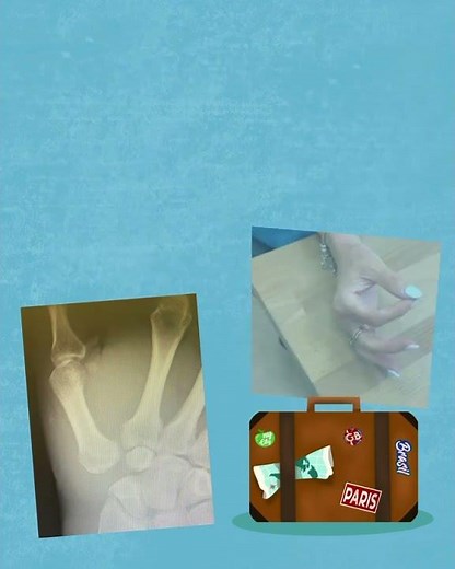 Local anesthesia trapeziectomy with LTRI for trapeziometacarpal joint osteoarthritis