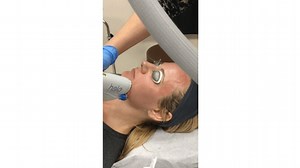 Skin Resurfacing With the Halo Laser