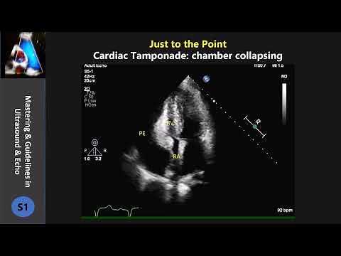 cardiac tamponade-collapsing chamber