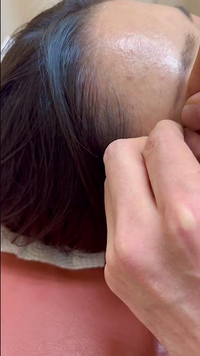 眼精疲労・目の疲れに効果的なツボ 太陽（たいよう）【鍼灸師解説】