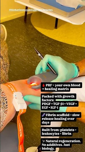 From Blood to Healing: PRF Membrane for a Sinus Lift! 🩸🦷