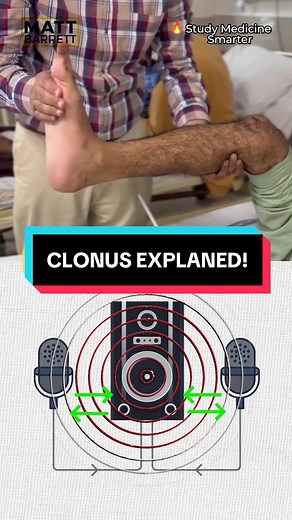 Understanding Clonus: A Guide for Medical Students