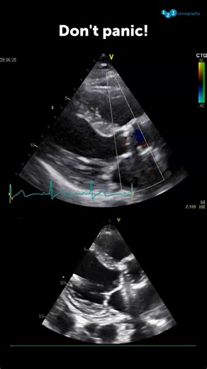 Which echocardiographic feature(s) is/are "physiologic" in mechanical bileaflet valves, and should not be mistaken as "abnormal"? A) Paravalvular regurgitation B) Closing volume (small regurgitation jets) C) Cavitations D) Strut impingement Share your answer and explanation with the community! ✍️ We just launched our Prosthetic Valve FocusClass. If you want to learn more, you can now benefit from our current offer 👉 https://zurl.co/lLMEb #echocardiographycourse #cardiologyeducation #ultrasoundk