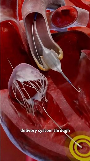 How does the TAVI Procedure help treat Aortic Valve Stenosis? Part 2