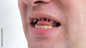 Periodontal disease, loose teeth in toothless man mouth, close up. Dental problems and orthodontic treatment for patient.