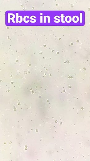 Rbcs in stool (40x view)#Pathology