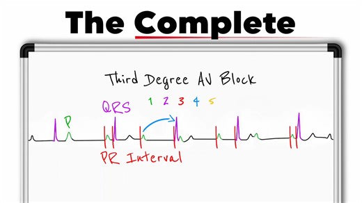 Third-Degree AV Block (Complete Heart Block) Explained | ECG Interpretation, Escape Rhythms & Pacemaker | Daily Cardiology