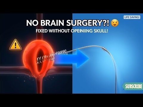 Inside Brain Surgery: Coil Embolization Saves a Life!