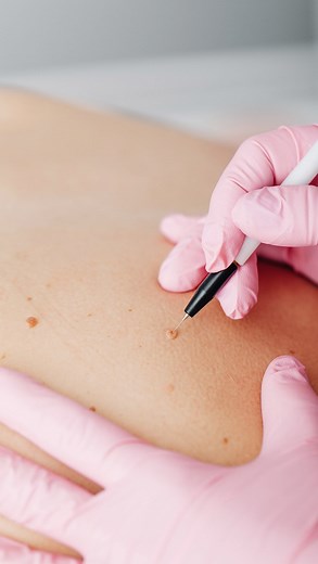 ✨Are you looking for smoother and clearer skin? Then our Thermo-Coagulation treatment may be right for you! Using a high-frequency current, it gently removes benign growths like skin tags, cherry angiomas, and more, with little to no downtime afterward. 💖Enjoy skin tag-free skin and book your appointment online today. - #surreymedispa #whiterockmedispa #whiterockmedspa #skincaregoals #thermocoagulation | Leah Corrin