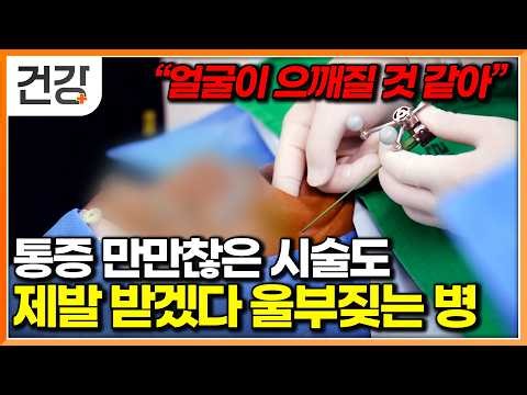 "Thunderclap" Facial Pain: Patients willing to insert two-span needles into their faces to escape...