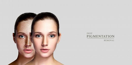 Deep Pigmentation Treatment Singapore | Ensoul Medical Clinic