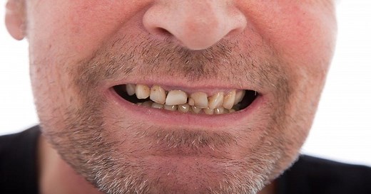Chipped Tooth Repair: Treatment Costs and Pain Relief - Dentaly.org