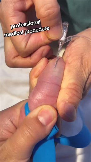Baby doesn't cry when getting a needle prick, #GoodBabyWhoDoesntCryWhenGettingIndwellingNeedle #FastGrowthPlan