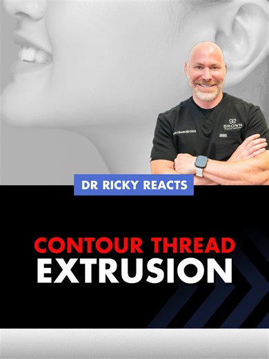 The Dangers of Contour Threads: A Cautionary Perspective