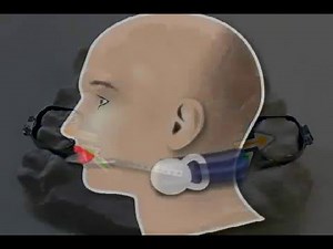 Wie werden Zahn Brackets am Zahn befestigt