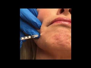 Kristen injecting Botox into the DAOs