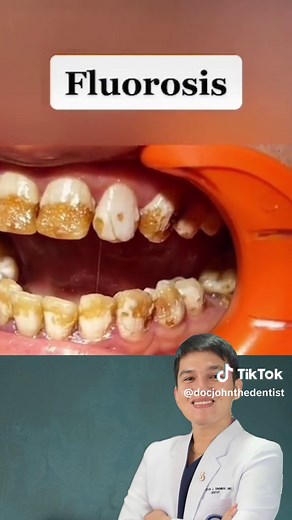Understanding Fluorosis: Types, Causes, and Treatment