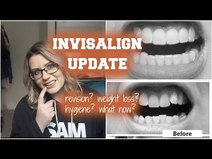 INVISALIGN UPDATE + AMAZING PROGRESS PHOTOS | 6 Months with Invisalign ✩ Kryzzleberry