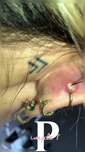 Episode 107 pimple behind ear 👂 #pimple #pimplepopper #pimplepop #puntosnegros