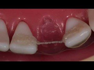 Ribbond Single Visit Bridge Technique