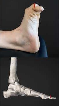 Wie Sie einen schmerzhaften Zeh ( Hallux valgus ) behandeln können ! ! !
