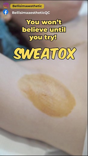 Stop underarm sweating before it starts! SWEATOX helps reduce excess sweating (or hyperhydrosis) of the underarms, palms & feet. Book with us! We are located at 2F 25 Shorthorn St. Project 8 Quezon City! 0915-93966070961-3416253#sweatox #underarmsweating #hyperhidrosis #sweatoxunderarms | Bellisima Aesthetics