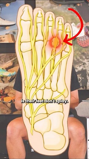 If you've been dealing with forefoot pain or numbness, this is worth understanding.
