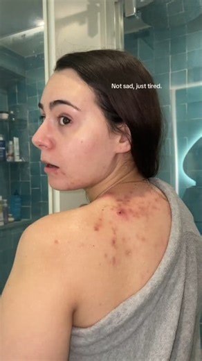 54K views · 114 reactions | 林 Step-by-step guide to using a 5% Benzoyl Peroxide Body Wash for Back Acne  #backacne #skincare | Dr Ankur Gautam | Facebook