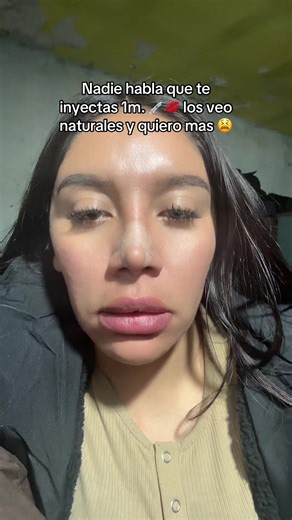 Labios Perfectos: Acido Hialuronico y Más