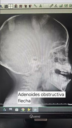 Aumento Volumen Adenoides #Hipertrofia #amigdalas #obstruccion