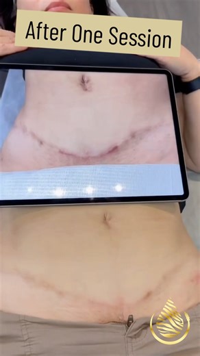 Dark Tummy Tuck Scar Lightened (1 Session)