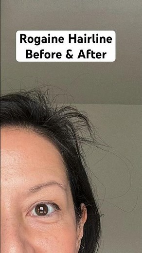 Rogaine Foam Hairline Before And After 💁🏻‍♀️ Minoxidil For Women