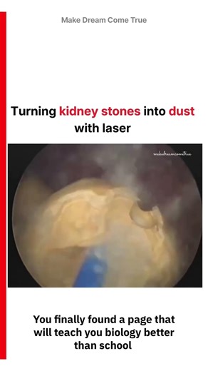 🪨 Turning kidney stones into dust with laser 🔬 | MDCT