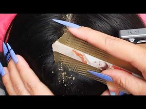 Close Up Itchy Scalp ASMR 🔍 Deep Scratch Therapy & Flake Lifting Sounds 000351