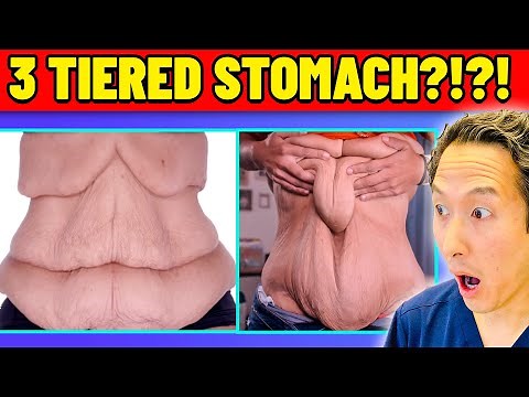 Losing 200 lbs Left Her With 3 Rolls of Skin! Doctor Reacts to Skin Tight!