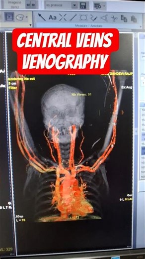 CT Central veins venography #shortsfeed #shortsviral #shorts