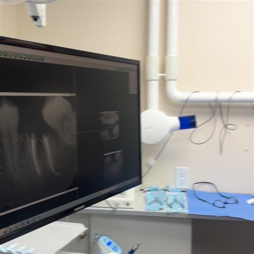 Extraction of a rotten #rootcanal #tooth on a 13 year old #girl. It was a relief to get that disintegrated and infected tooth out. Despite the fact that the tooth behind it was leaning over the distal root, I managed to elevate it after removing the front root. I curetted the bone thoroughly, applied #ozone gas, grafted the socket with bio oss collagen, and overlaid it with two plugs of #PRF. This little girl did surprisingly well even with her blood draw. #biologicaldentistry #oralsurgery #chil