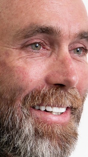 Dental Implants Transformation: Before and After Results