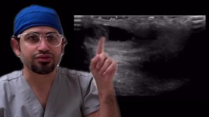 Torsed appendix testis Very common in pediatrics. You’ll often see a round mass between the head of the epididymis and testis that has a speckled appearance compared to the testicle and epi that have homogenous smooth mid level echoes… | John Z Wetmore