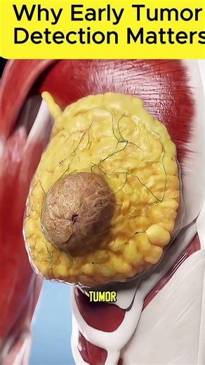 How quickly breast tumors can develop. #breastcancer #awareness #facts