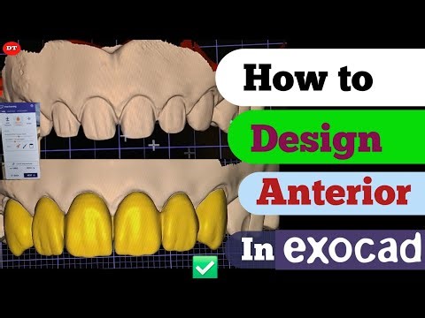 How To Design Anterior in Exocad| Exocad anterior design tutorial| Smile design in Exocad| dentallab